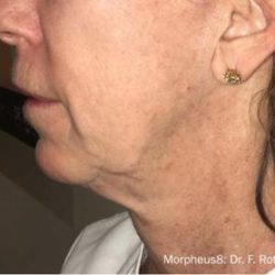 Morpheus8 Before & After Patient #1628